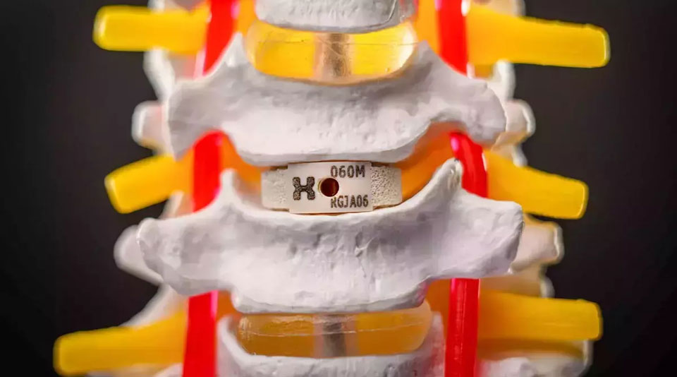 Anatomical model of vertebrae with an artificial spinal disc implant.