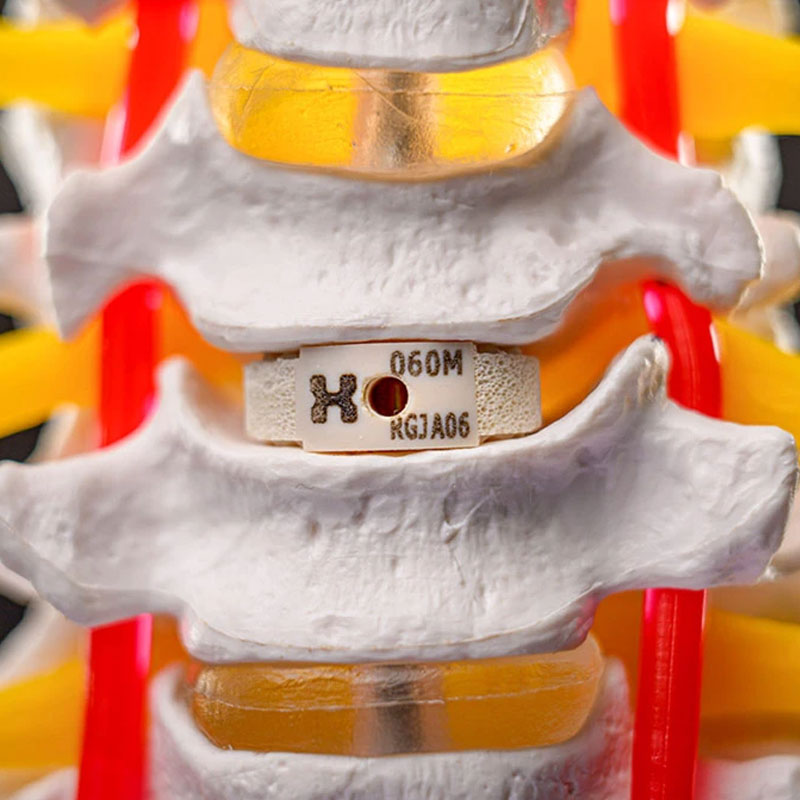 Close-up of a model spine with a small, white, rectangular implant between two vertebrae. Red and yellow spinal ligaments are visible.